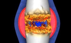 Rheumatoid arthritis