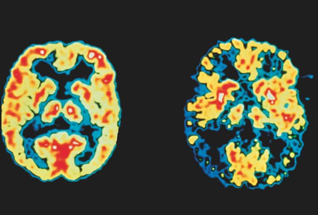 Images of a normal brain and an Alzheimer's brain