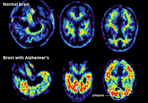 Alzheimer’s image