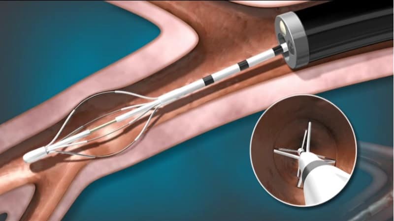 bronchial_thermoplasty