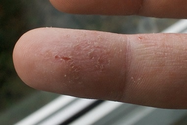 eczema_finger