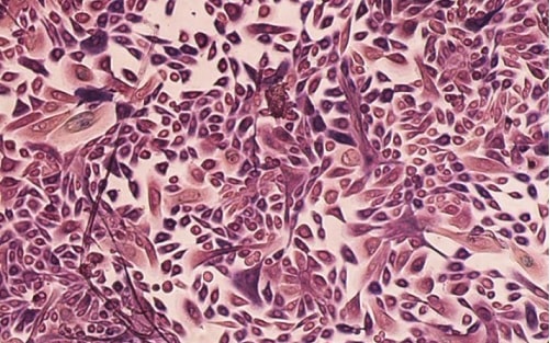 cancer_cells_from_the_breast_cancer_now_tissue_bank_cell_programme