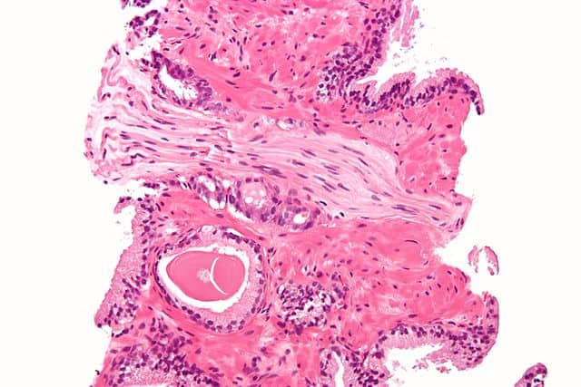 640px-prostatic_adenocarcinoma_with_perineural_invasion