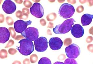 acute_lymphoblastic_leukaemia_smear