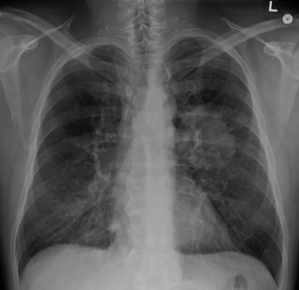 lung_cancer_on_chest_x-ray